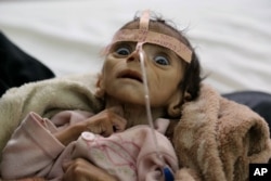 FILE - In this March 22, 2016 photo, infant Udai Faisal, who is suffering from acute malnutrition, is hospitalized at Al-Sabeen Hospital in Sanaa, Yemen.